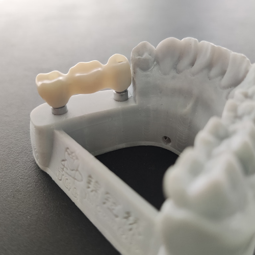 Zirconia implant crowns and bridges by LexaDent Studio