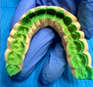 2-Stage silicone provisional matrix by LexaDent Studio