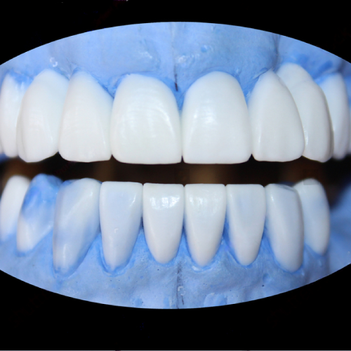 Hand-waxed diagnostic dental model by LexaDent Studio