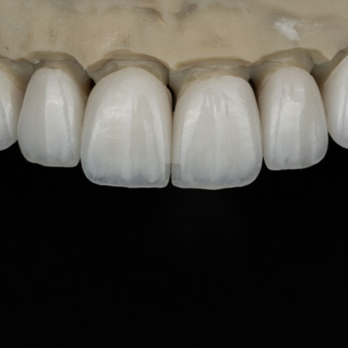 Hand-layered zirconia ceramic restorations by LexaDent Studio