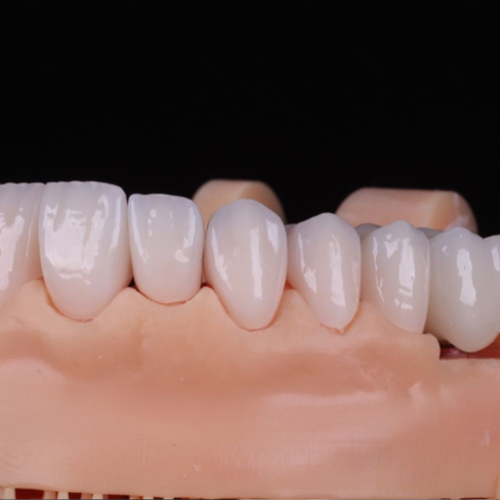 Lithium Disilicate implant restorations by LexaDent Studio