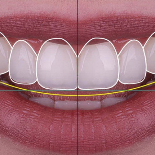 Digital Smile creation for cosmetic dental treatment planning