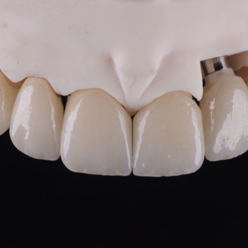 Lithium disilicate restorations by LexaDent Studio